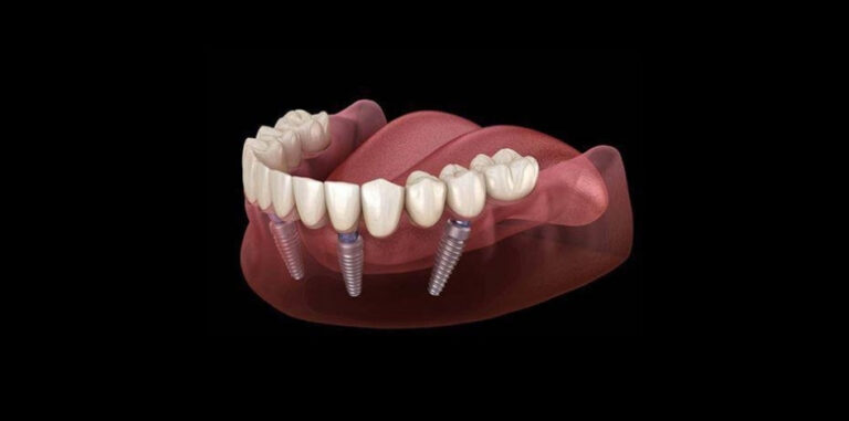 Implantes Dentales All On 4