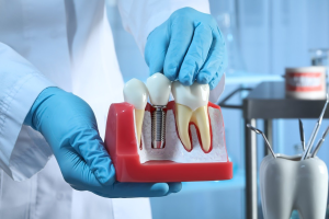 implantes dentales barato quito ecuador- Zirconia Dental