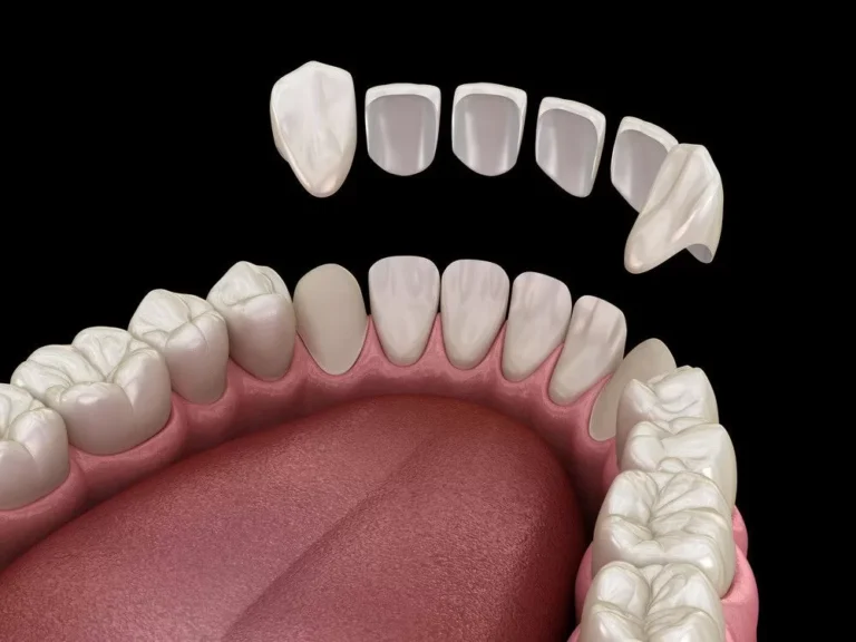 Carillas Dentales, la transformación estética para tu sonrisa