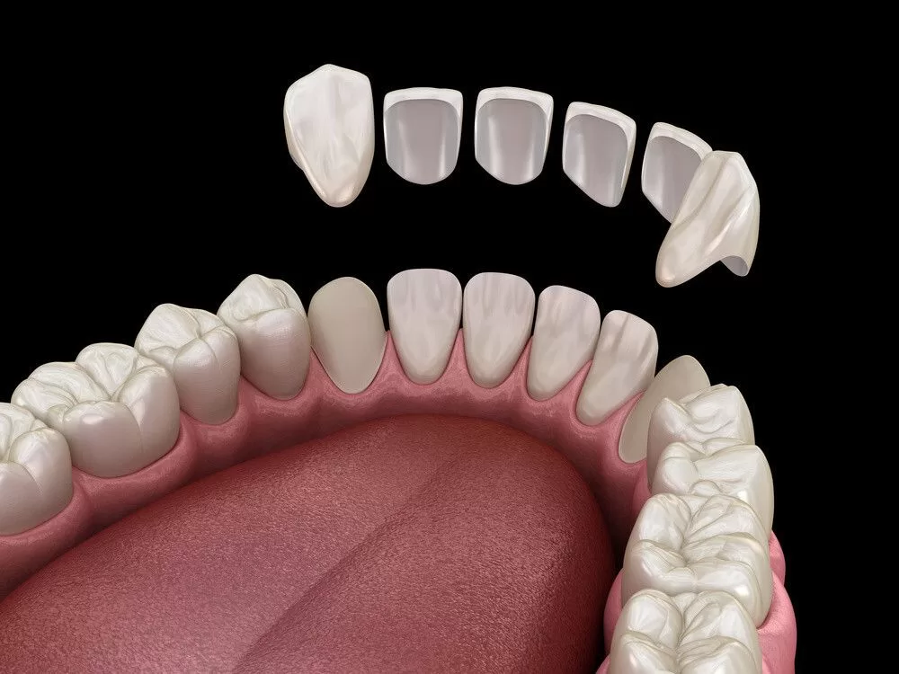 CARILLAS DENTALES - ZIRCONIA DENTAL - BARATO - QUITO - ECUADOR 
estética dental  
