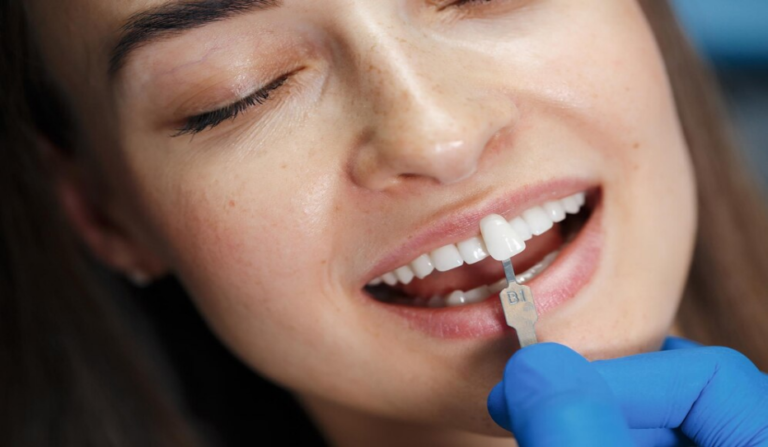 Blanqueamiento Dental (ACLARAMIENTO)