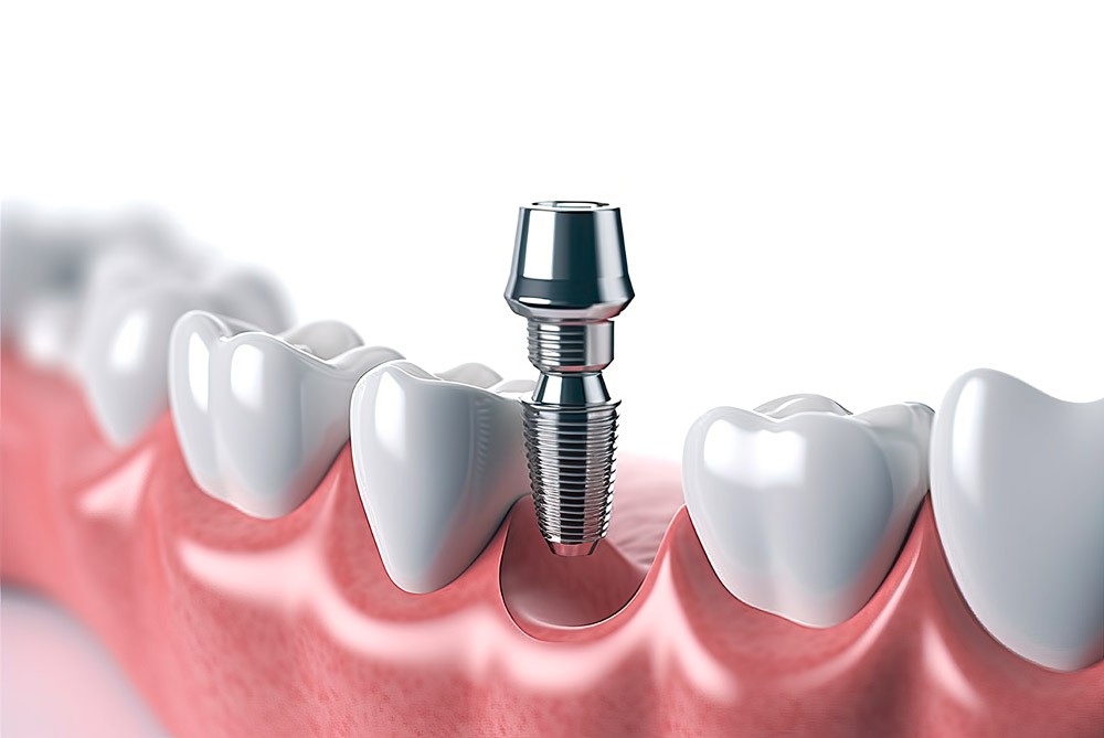 Implantes dentales de zirconio