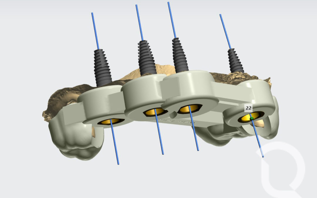 Cirugía Guiada Implantes dentales