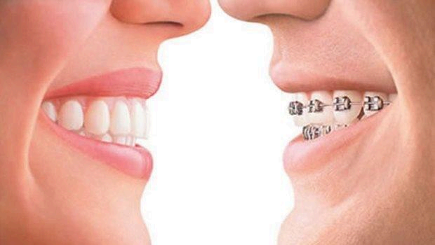Invisalign ortodoncia sin brackets