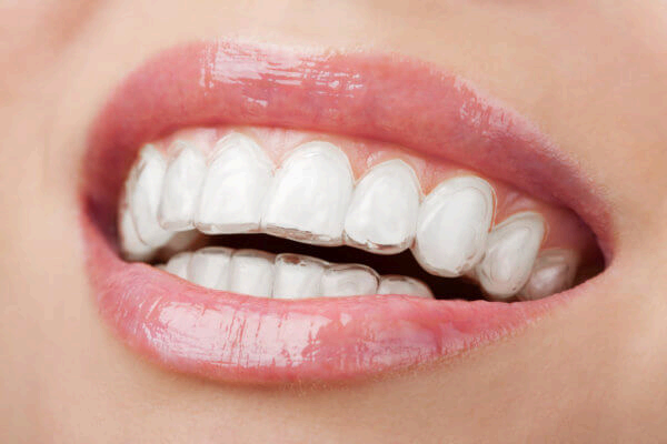INVISALIGN ortodoncia sin brackets
